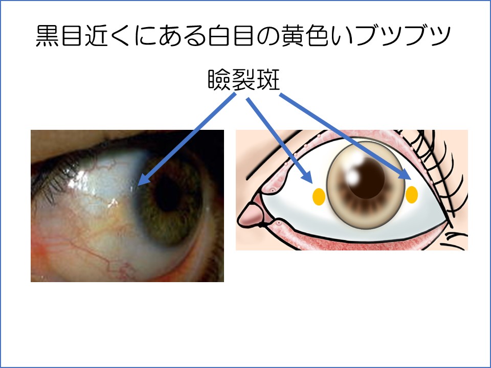 🚫รุ่นใหม่ล่าสุด!!!!! Iris 40 ยาหยอดตาลดการตาขาวเหลืองจากญี่ปุ่น